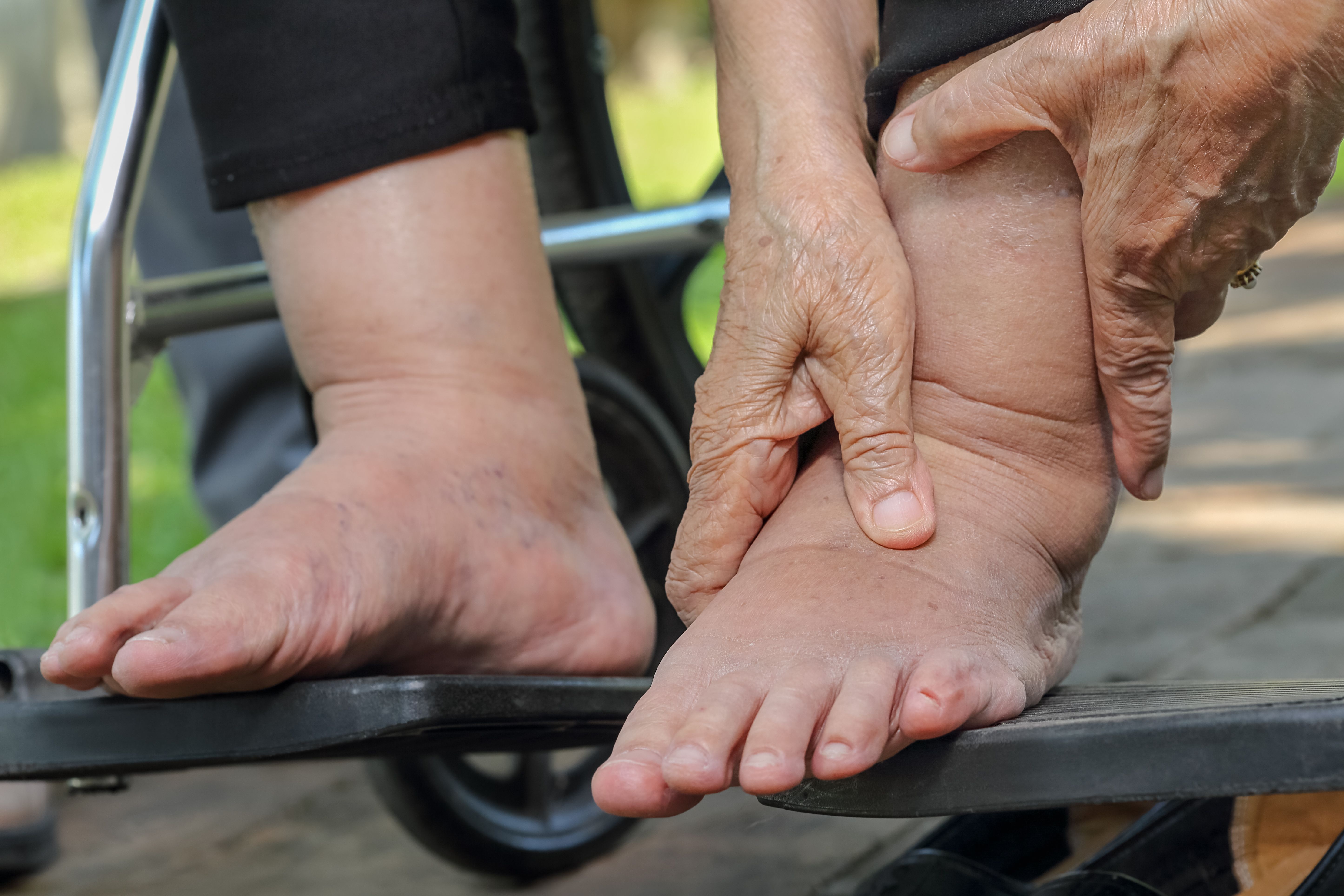 elderly-woman-swollen-feet-press-test-wheelchair.jpg