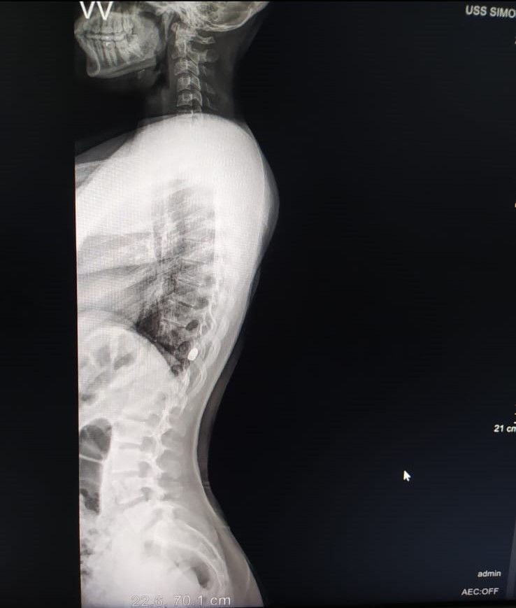 Radiografía victima de bala
